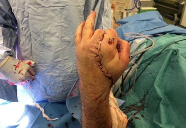 Carpenters hand repaired after 17 hours of surgery